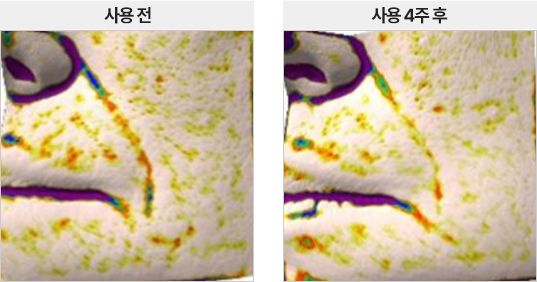 스킨 사용 전/후 팔자 부위 주름 차이
